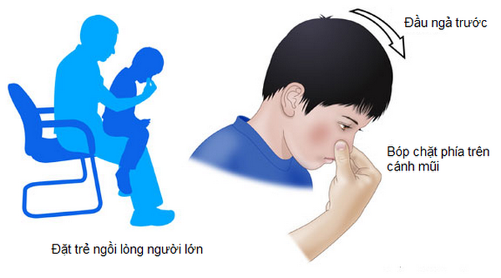 Đặt trẻ ngồi thẳng, đầu và cổ hơi ngả về trước. Tư thế này giúp máu không chảy xuống họng, tránh gây nôn .